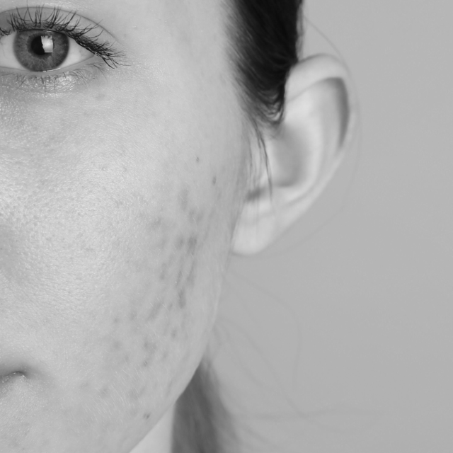 acne scar treatment mono cover