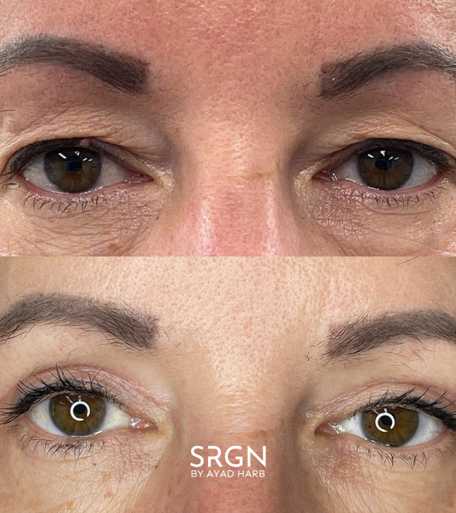 brown eyes blepharoplasty results