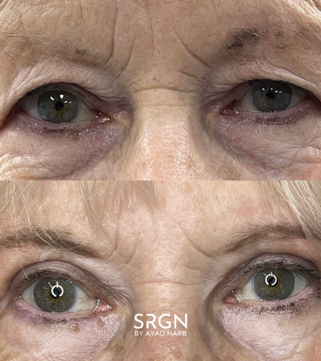 bleph before and after green eyes