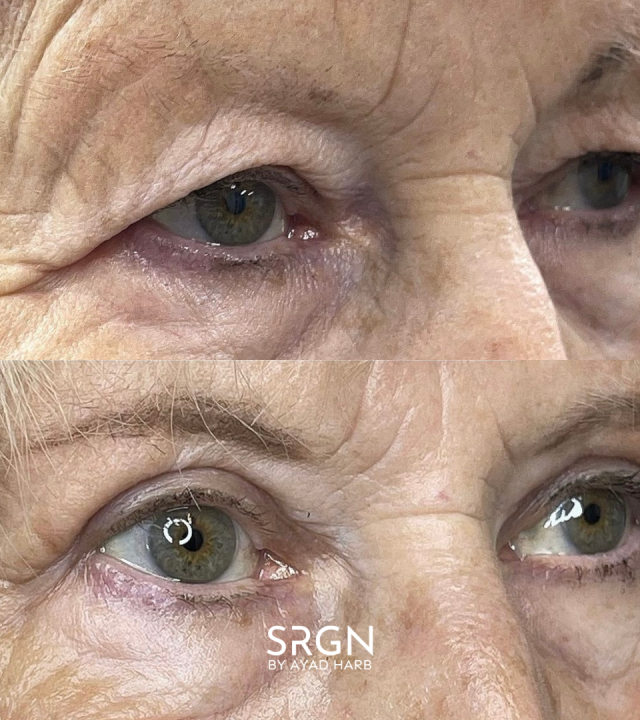 blepharoplasty before and after front view