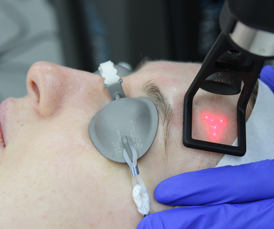 CO2 COOL PEEL TREATMENT IN CLINIC