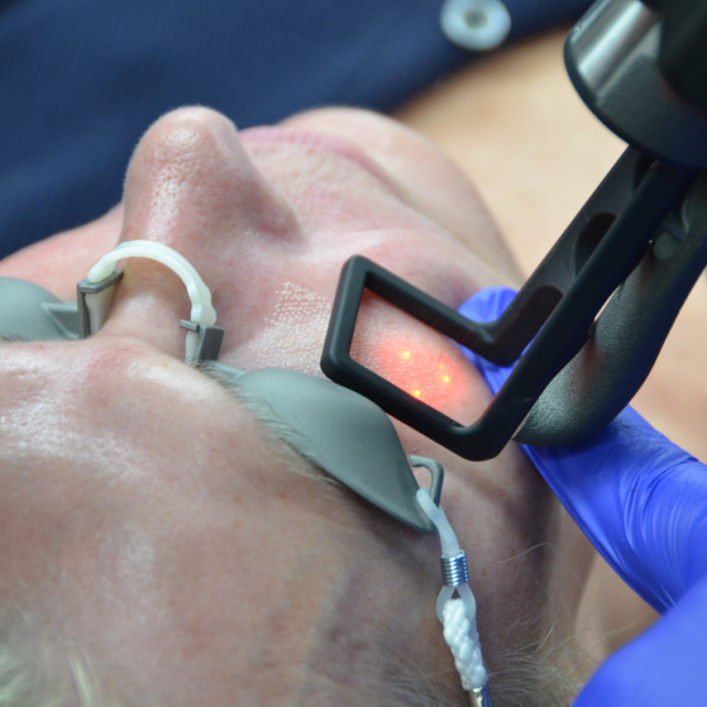 CO2 Laser Resurfacing
