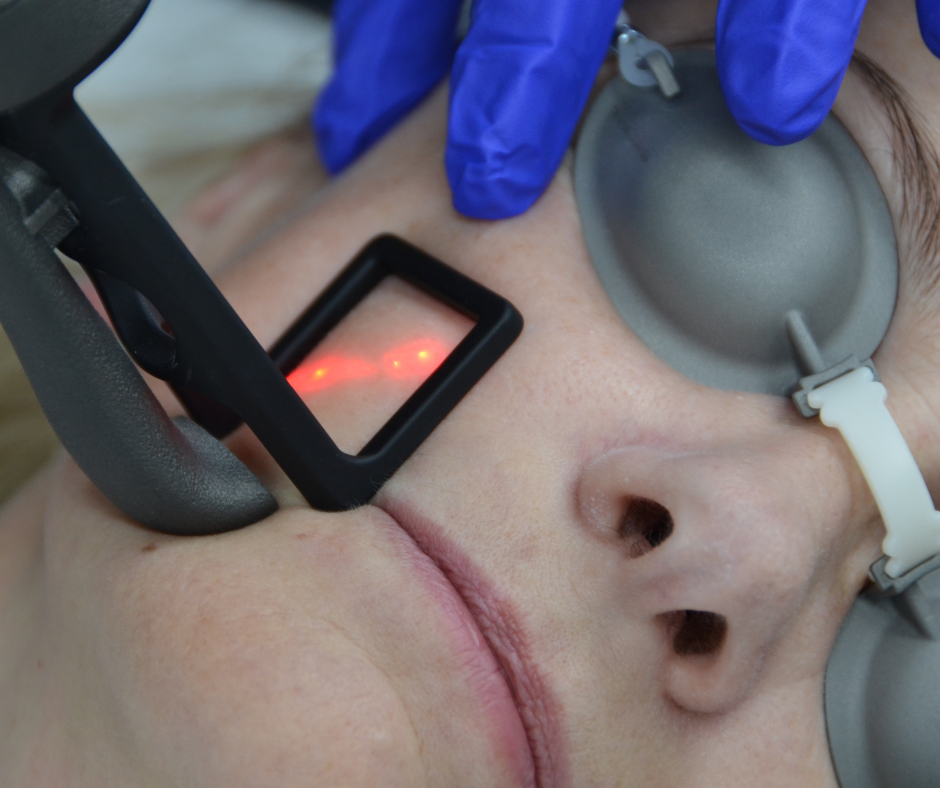 CO2 LASER FACE TREATMENT